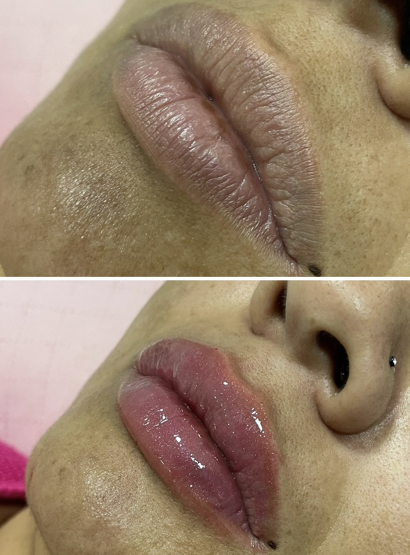 Resultado Toxina Botulínica